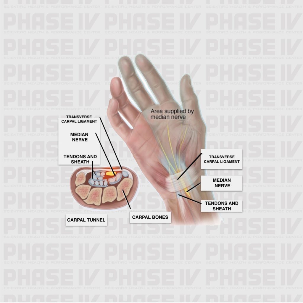 CARPAL TUNNEL SYNDROME