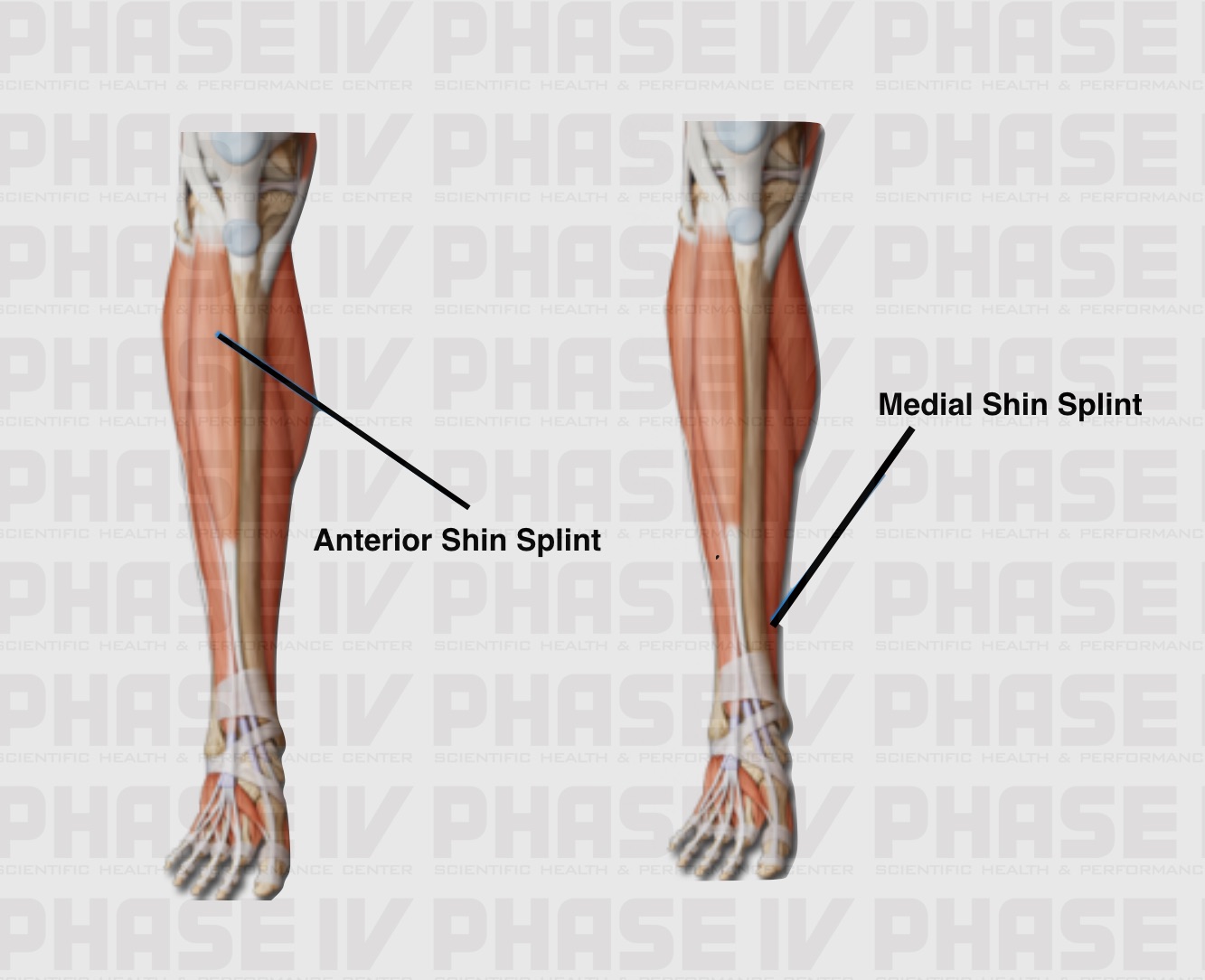 SHIN SPLINTS