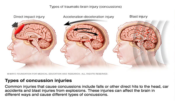 what are the 5 types of concussions